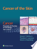 Cancer of the skin /