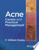 Acne : causes and practical management /